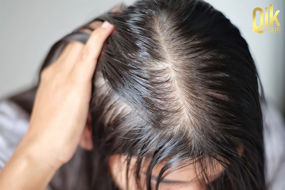 Hơn 100 ảnh về cách hạn chế rụng tóc nam  daotaoneceduvn