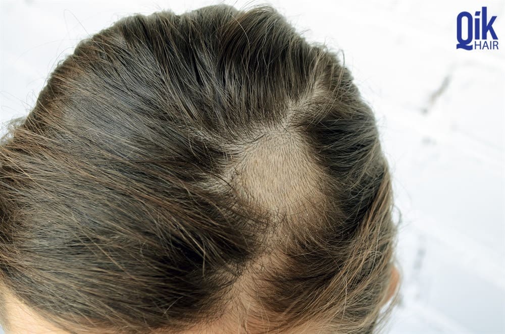 nấm da đầu gây rụng tóc và hói đầu