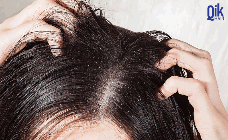 tóc khô xơ sau sinh do nấm da đầu