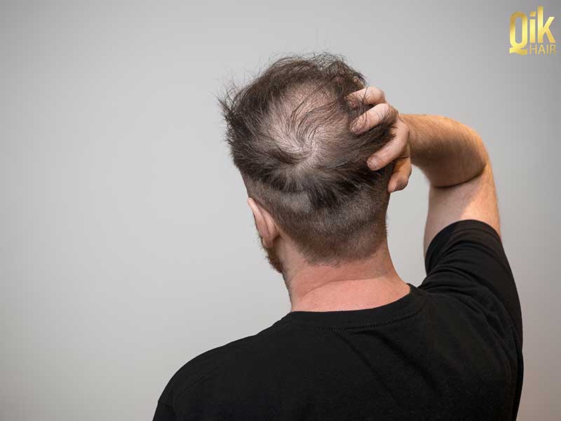 rụng tóc toàn thể có thể gây hói đầu
