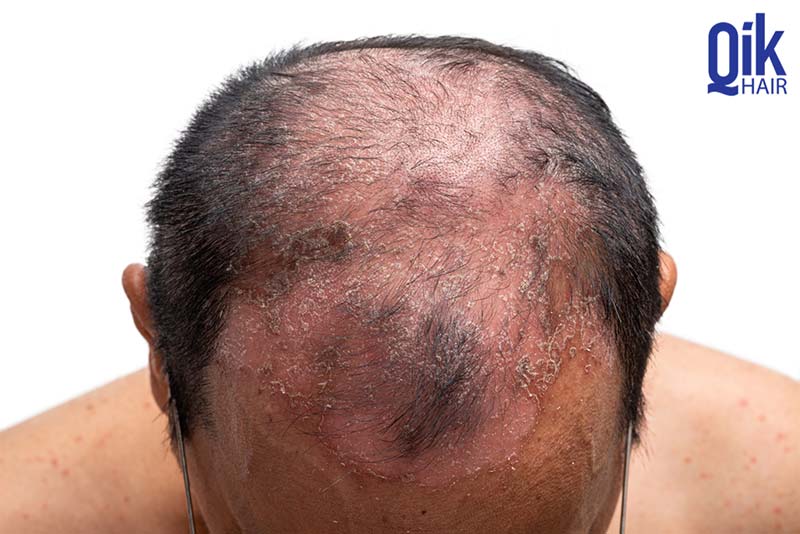 hói đỉnh đầu do bệnh da đầu