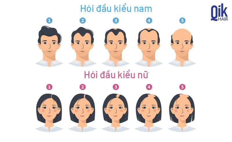 quá trình hói đỉnh đầu
