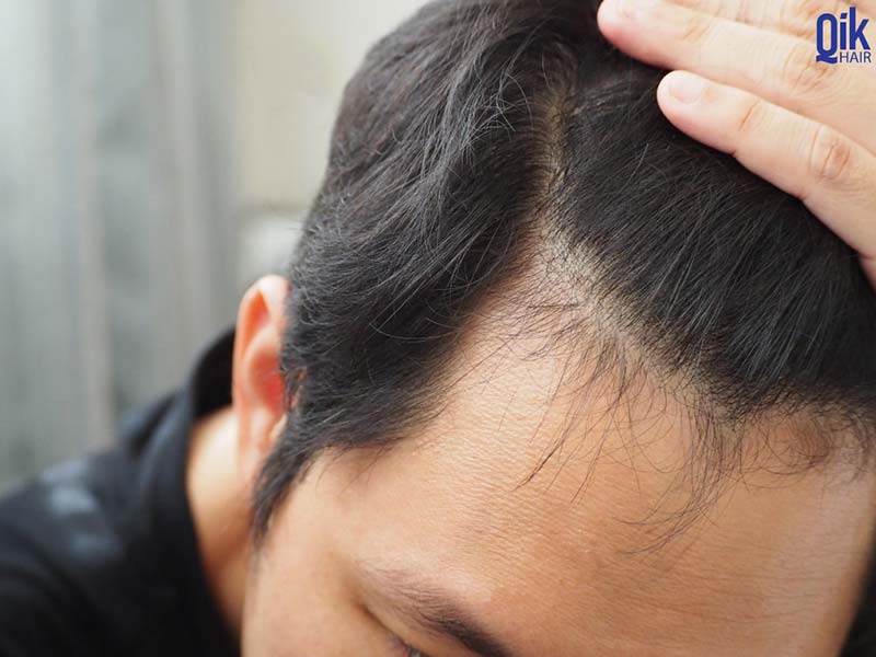 tóc con xuất hiện