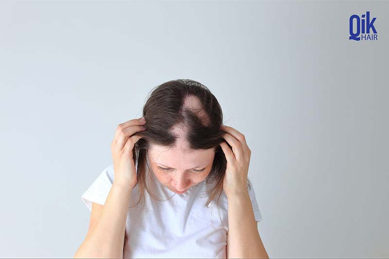 người phụ nữ bị rụng tóc từng mảng