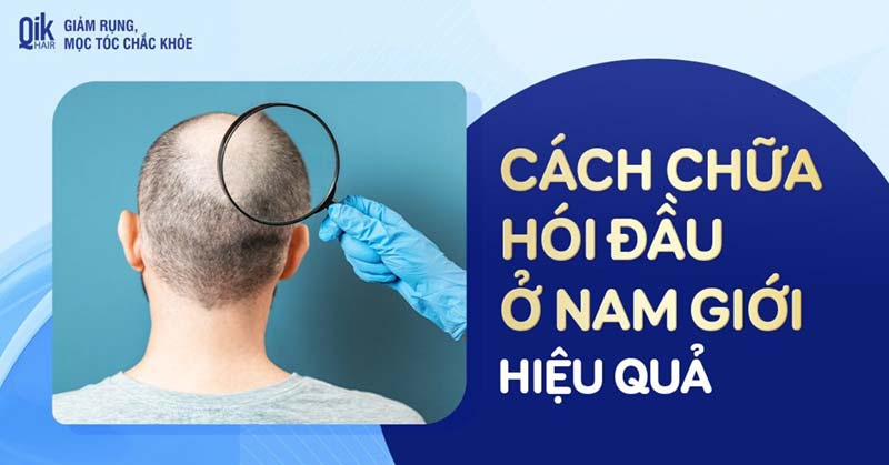 cách chữa hói đầu ở nam giới