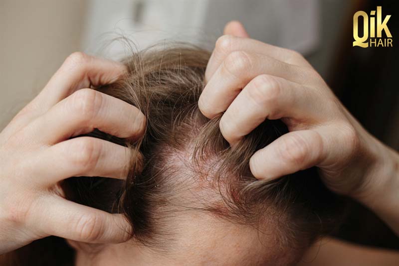 một số trường hợp dùng thuốc mọc tóc gây kích ứng da đầu