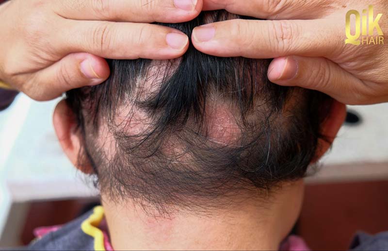rụng tóc từng mảng ở người lớn tuổi