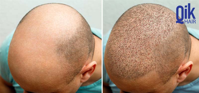 trước và sau cấy tóc