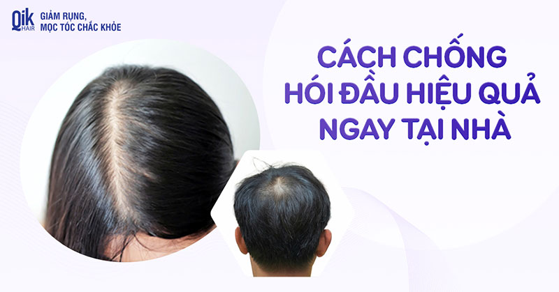10 cách chống hói đầu tại nhà đơn giản và hiệu quả