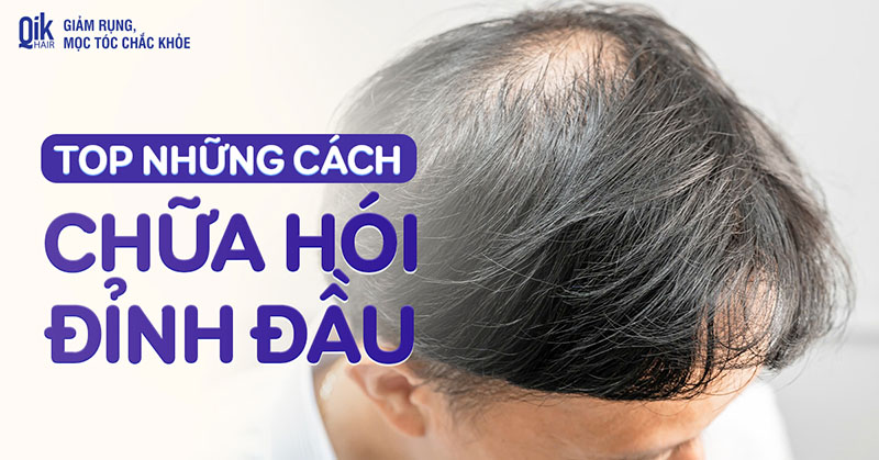 chữa hói đỉnh đầu