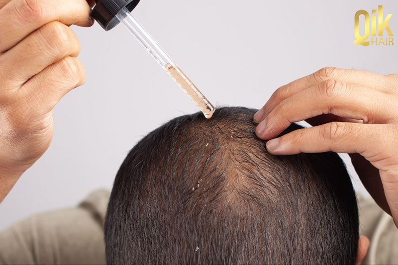thoa minoxidil