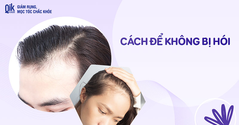 6 cách để không bị hói đầu có thể áp dụng ngay tại nhà