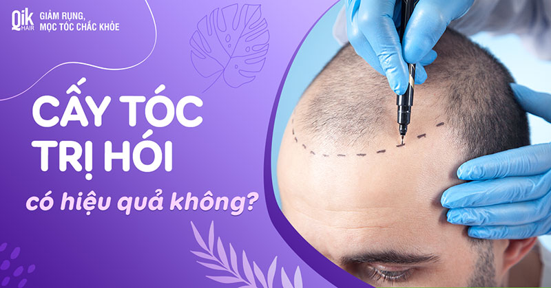 Cấy tóc trị hói có hiệu quả không? Ai nên chữa hói bằng cách này?