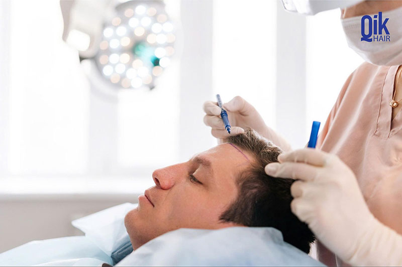 gây tê trước khi cấy tóc