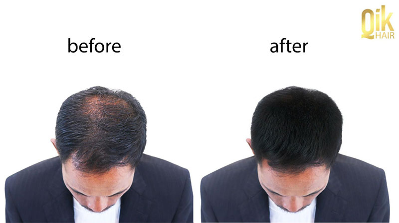 trước và sau cấy tóc